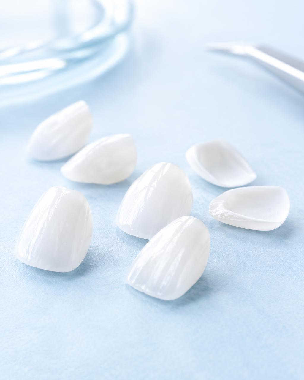 Hauchdünne Veneers aus Keramik
